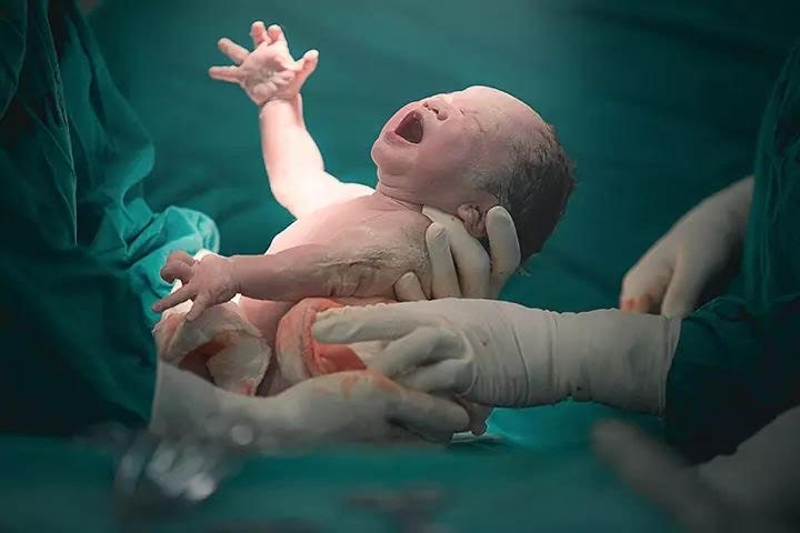 عکس نوزاد تازه متولد شده در دستان پزشکان در حال گریه.
A newborn baby crying in the hands of doctors